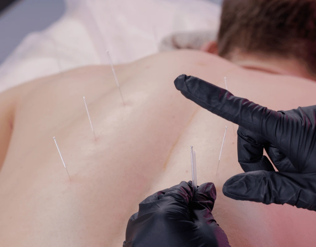 Several fine needles inserted along a patients upper back while a gloved clinician positions another